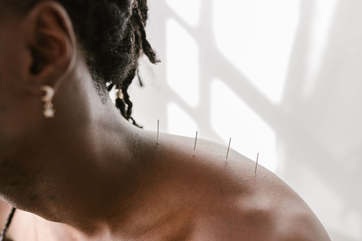 Fine acupuncture needles placed along a shoulder during treatment